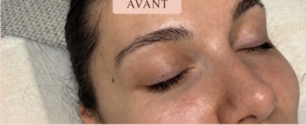 Avant BROWLIFT